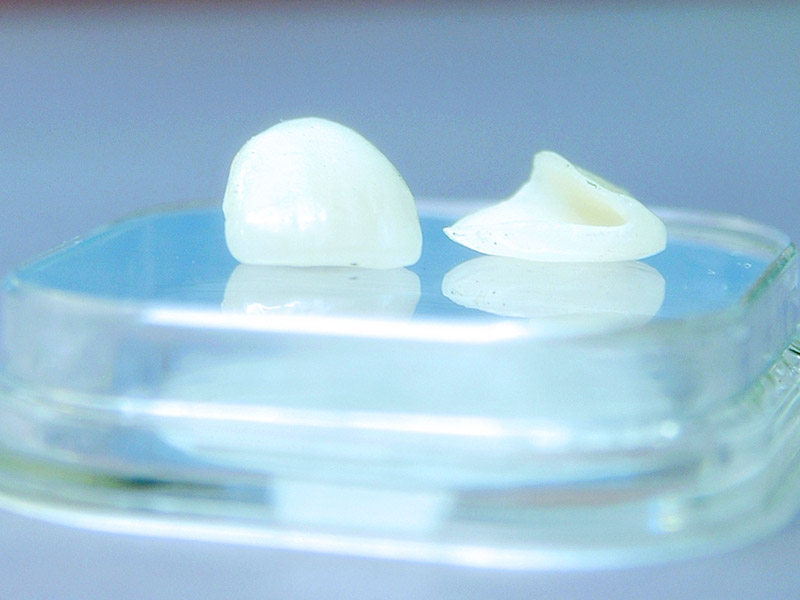 verblendschalen veneers